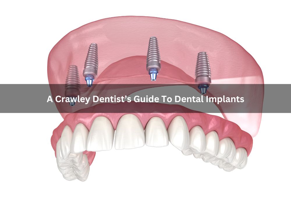 A Crawley Dentist’s Guide To Dental Implants