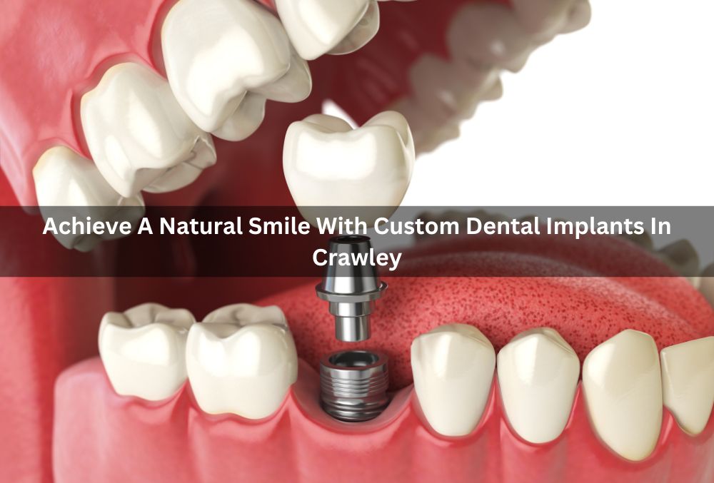 Achieve A Natural Smile With Custom Dental Implants In Crawley