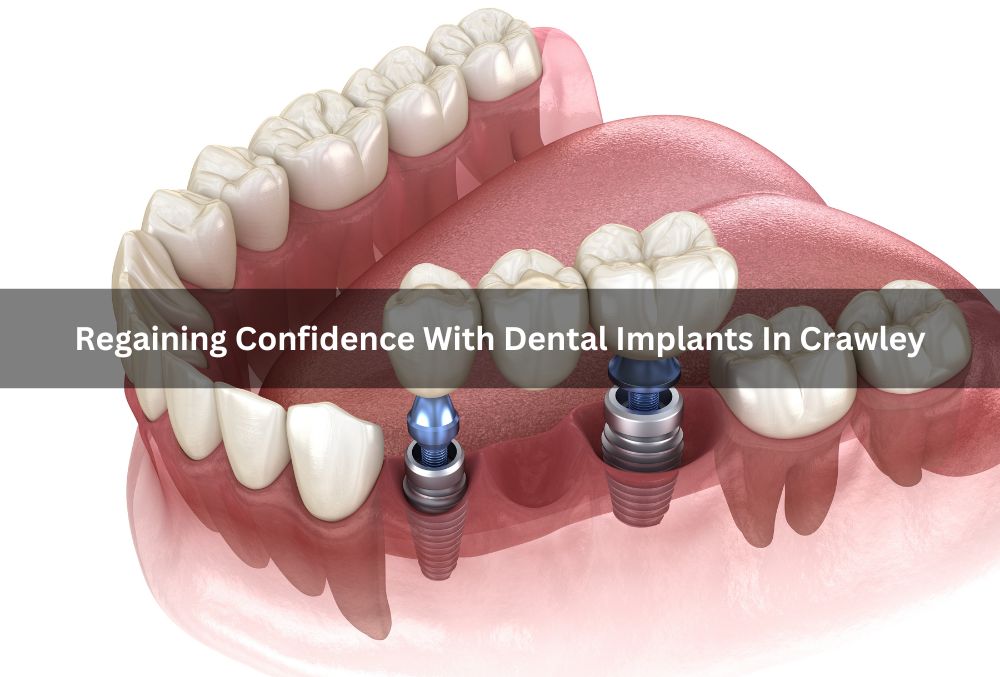 Regaining Confidence With Dental Implants In Crawley